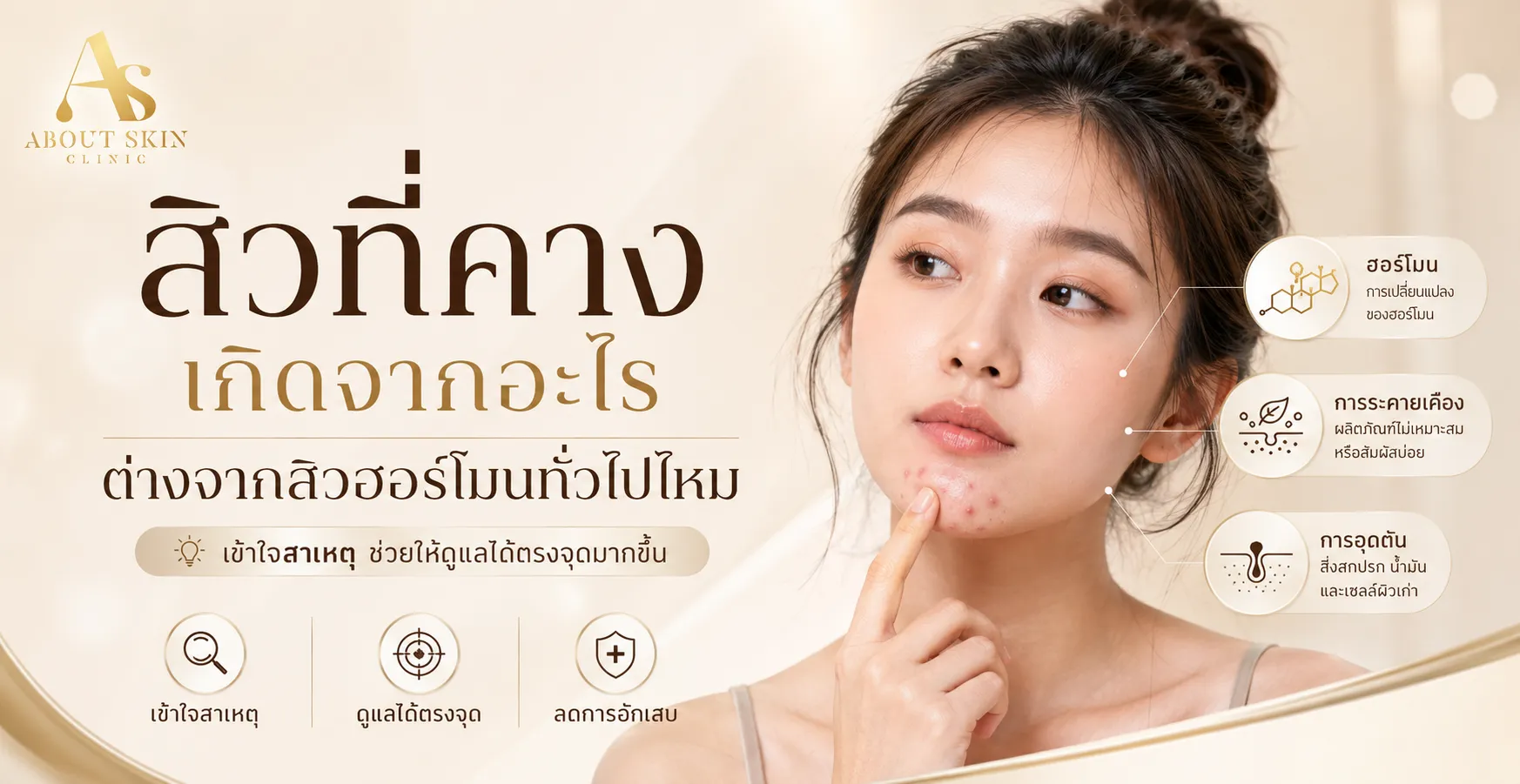 ภาพประกอบบทความ สิวที่คาง เกิดจากอะไร ต่างจากสิวฮอร์โมนทั่วไปไหม - About Skin Clinic