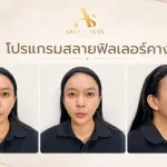 โปรแกรมสลายฟิลเลอร์คาง คำถามที่พบบ่อย | About Skin Clinic