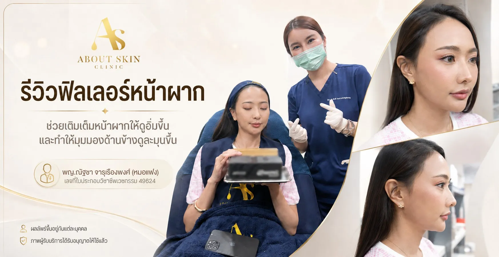 รีวิวเคสฟิลเลอร์หน้าผาก หมอแฟง About Skin Clinic