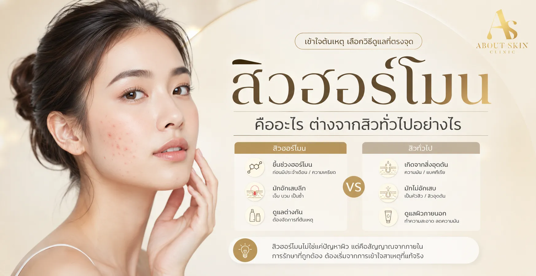 ภาพประกอบบทความ สิวฮอร์โมน คืออะไร ต่างจากสิวทั่วไปอย่างไร - About Skin Clinic