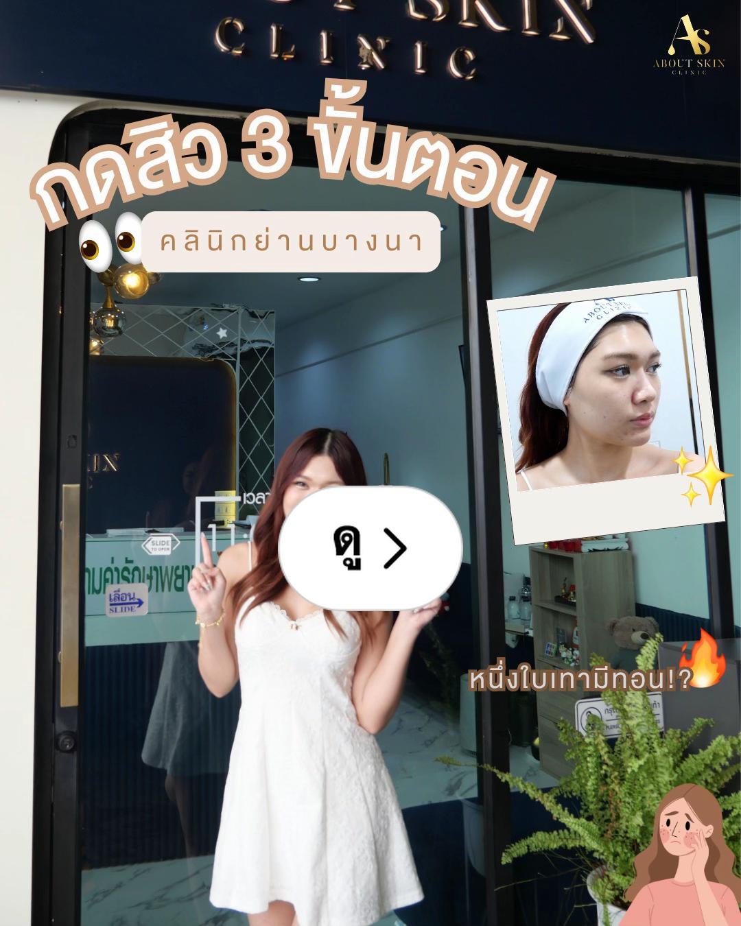 邦纳分店祛痘 3 步骤实拍分享 - About Skin Clinic Lemon8