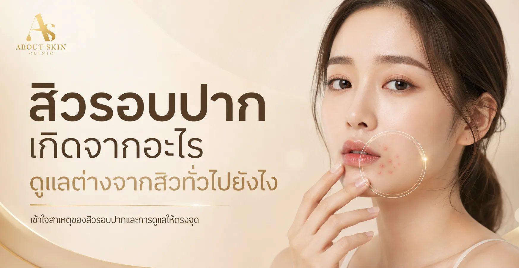 ภาพประกอบบทความ สิวรอบปาก เกิดจากอะไร ดูแลต่างจากสิวทั่วไปยังไง - About Skin Clinic