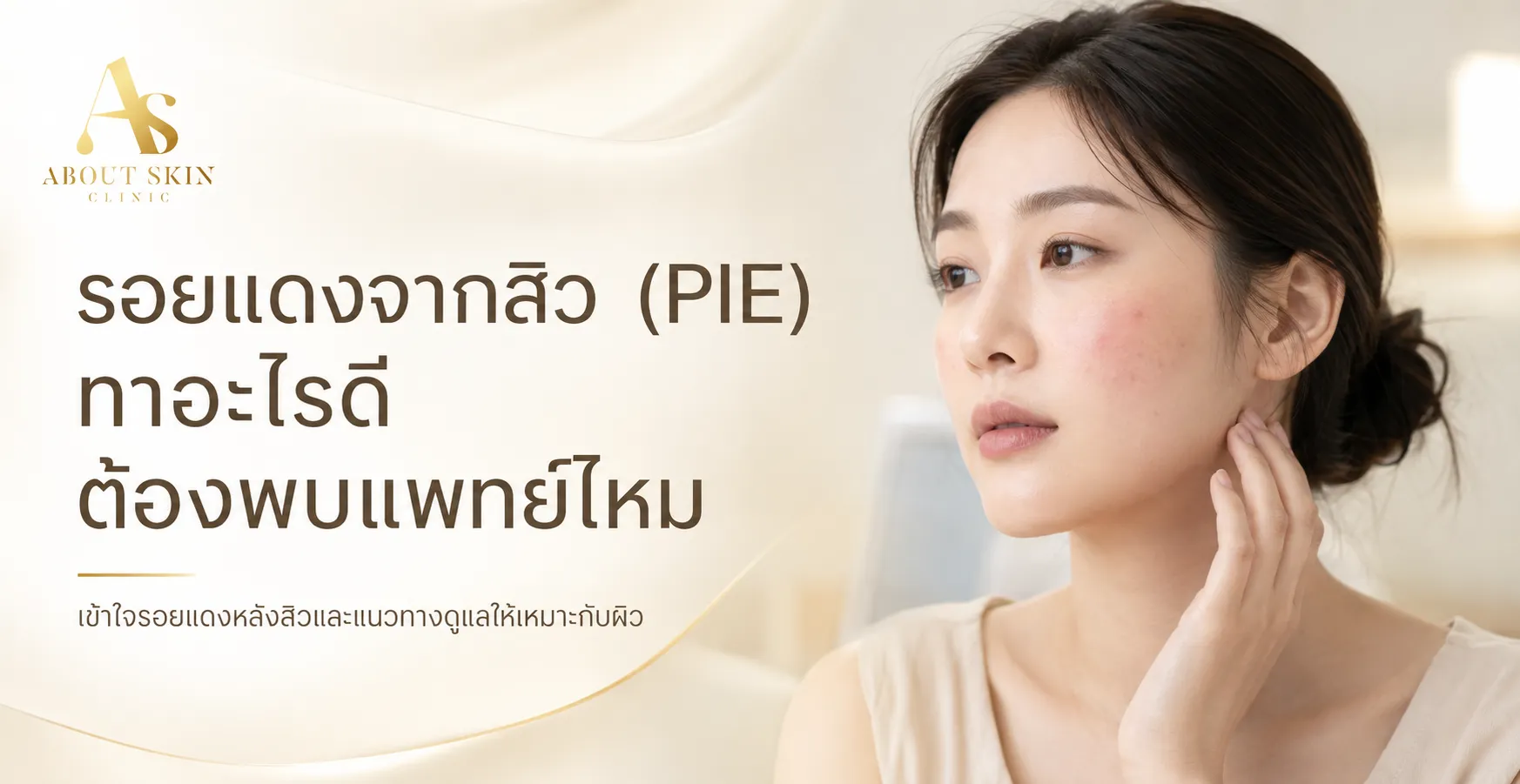 ภาพประกอบบทความ รอยแดงจากสิว (PIE) ทาอะไรดี ต้องพบแพทย์ไหม - About Skin Clinic