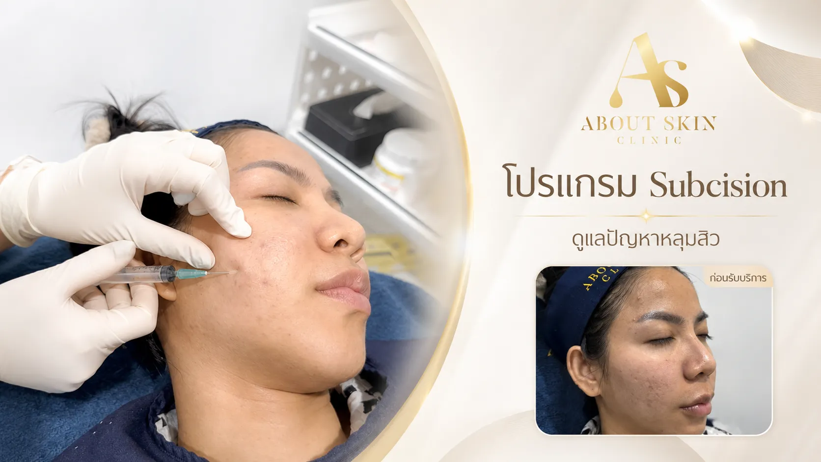 โปรแกรม Subcision — เคสจริง ทีมแพทย์ About Skin Clinic