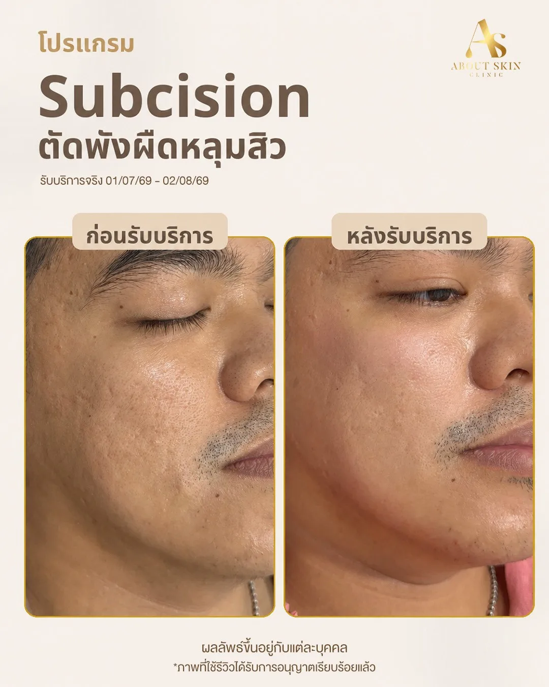 ผลลัพธ์ก่อนหลัง Subcision หลุมสิว คนไข้ชาย About Skin Clinic