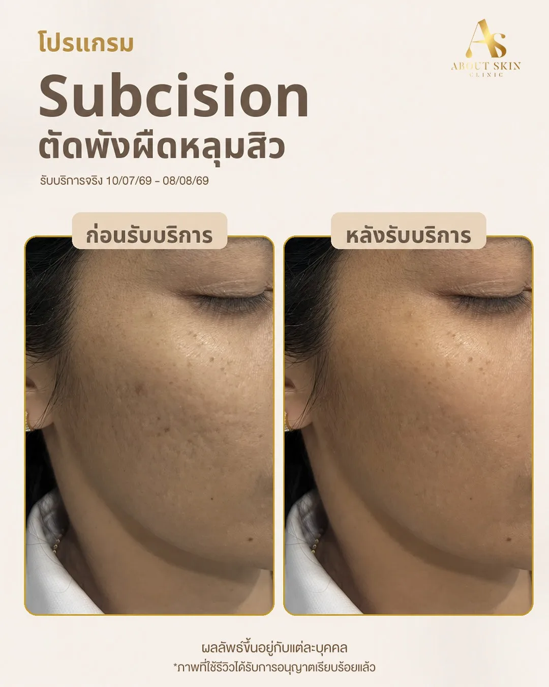 ผลลัพธ์ก่อนหลัง Subcision หลุมสิว About Skin Clinic เคส 10