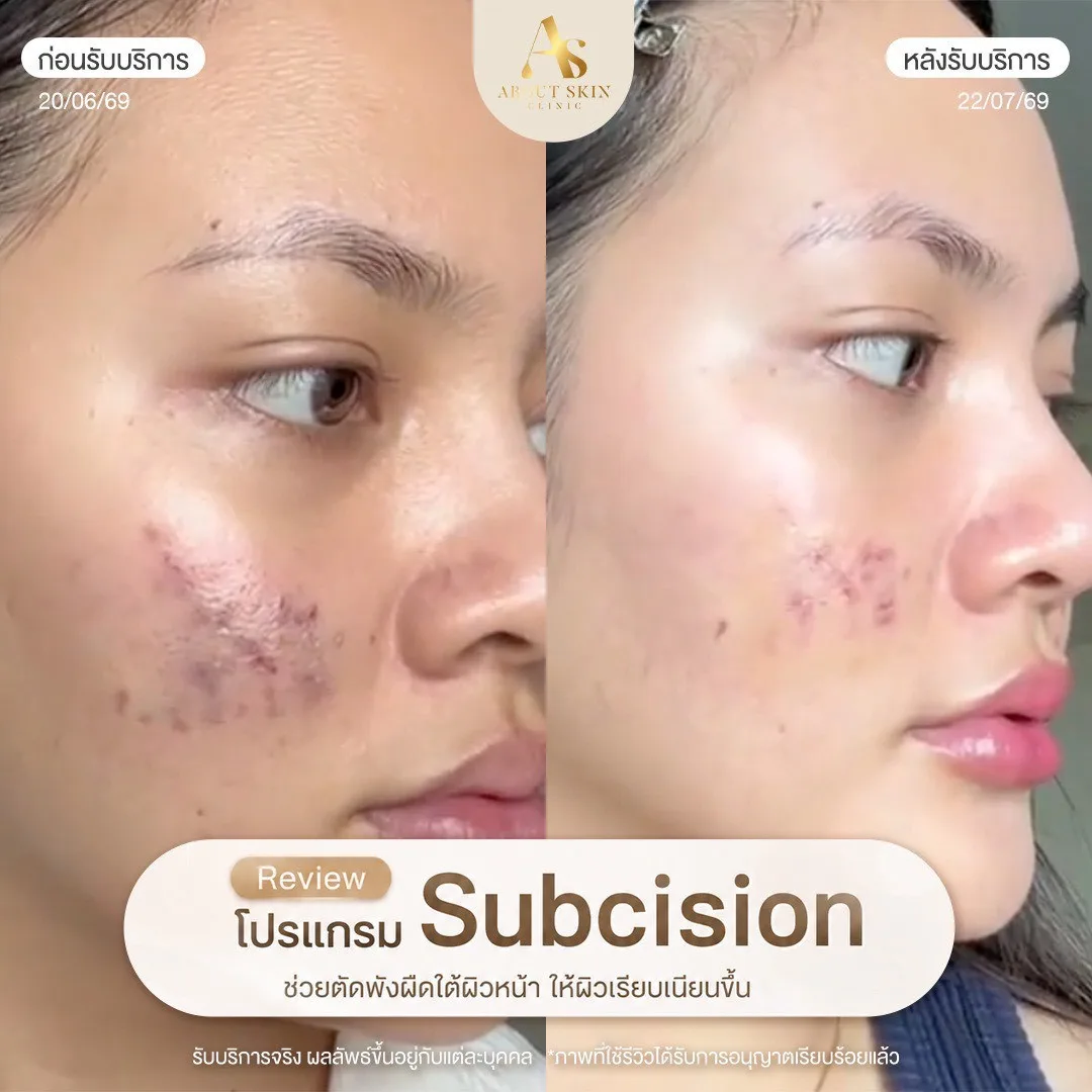 รีวิวผลลัพธ์ Subcision หลุมสิว About Skin Clinic