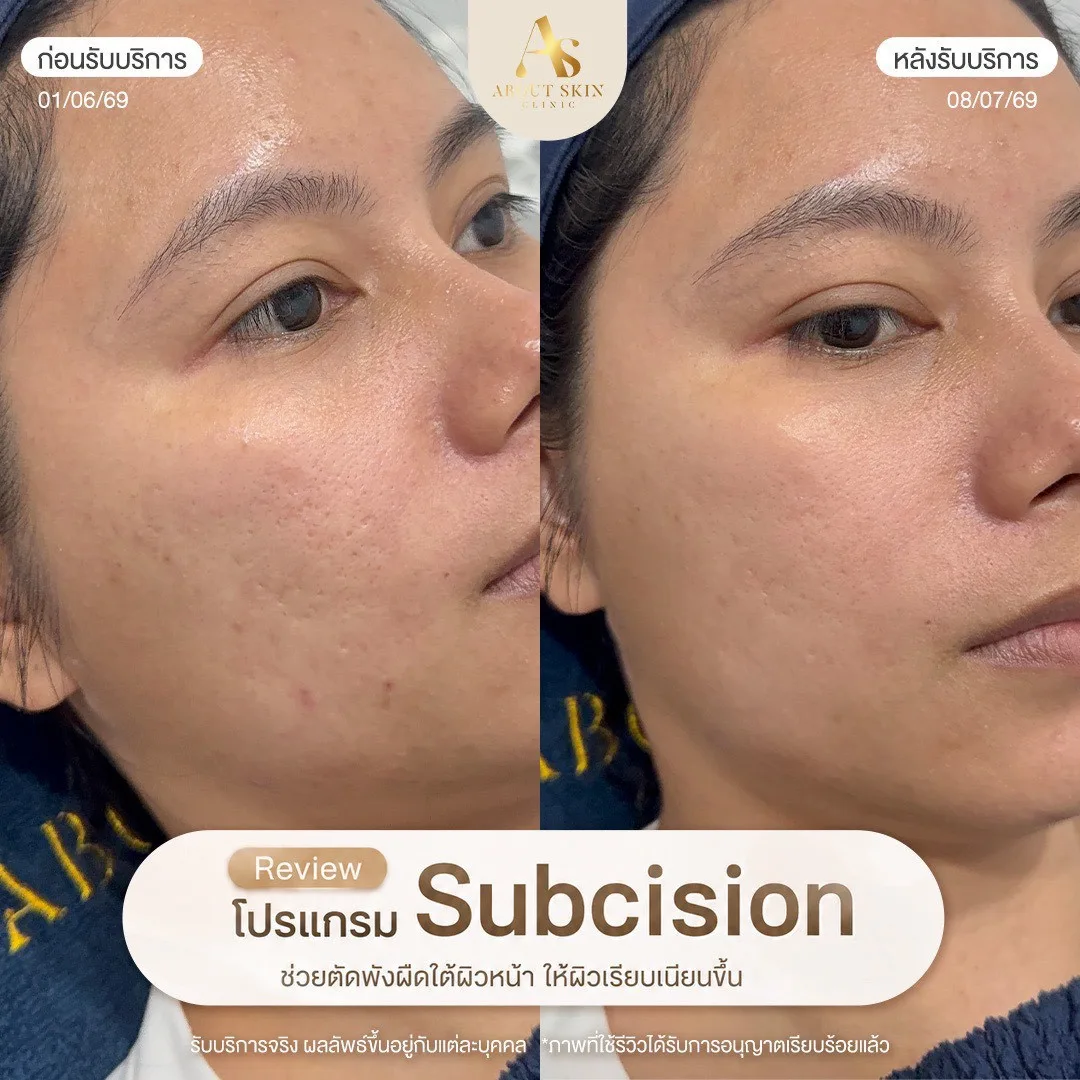 ผลลัพธ์ก่อนหลัง Subcision หลุมสิว About Skin Clinic เคส 12