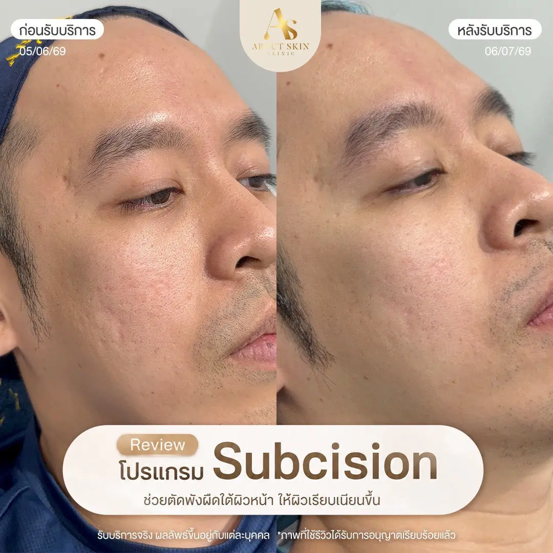 ผลลัพธ์ก่อนหลัง Subcision หลุมสิว About Skin Clinic เคส 13