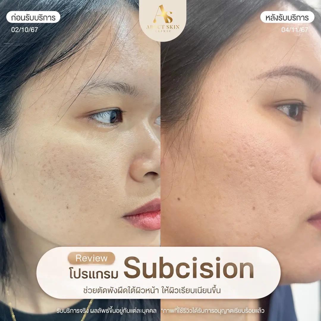 ผลลัพธ์ก่อนหลัง Subcision หลุมสิว About Skin Clinic เคส 14