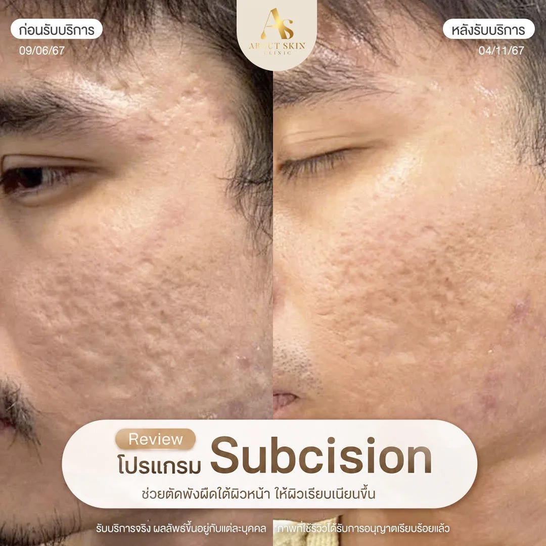 รีวิวผลลัพธ์ Subcision หลุมสิว About Skin Clinic