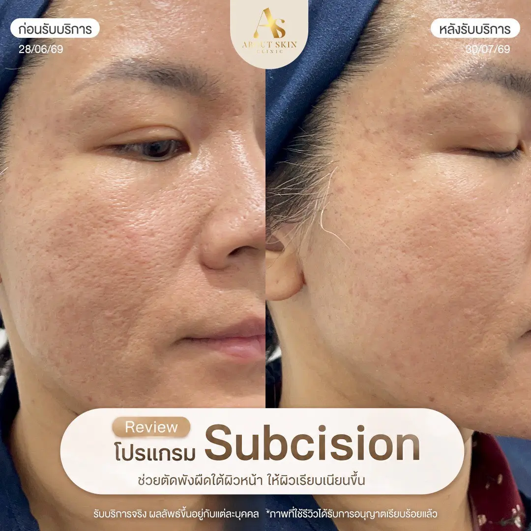 ผลลัพธ์ก่อนหลัง Subcision หลุมสิว About Skin Clinic เคส 16