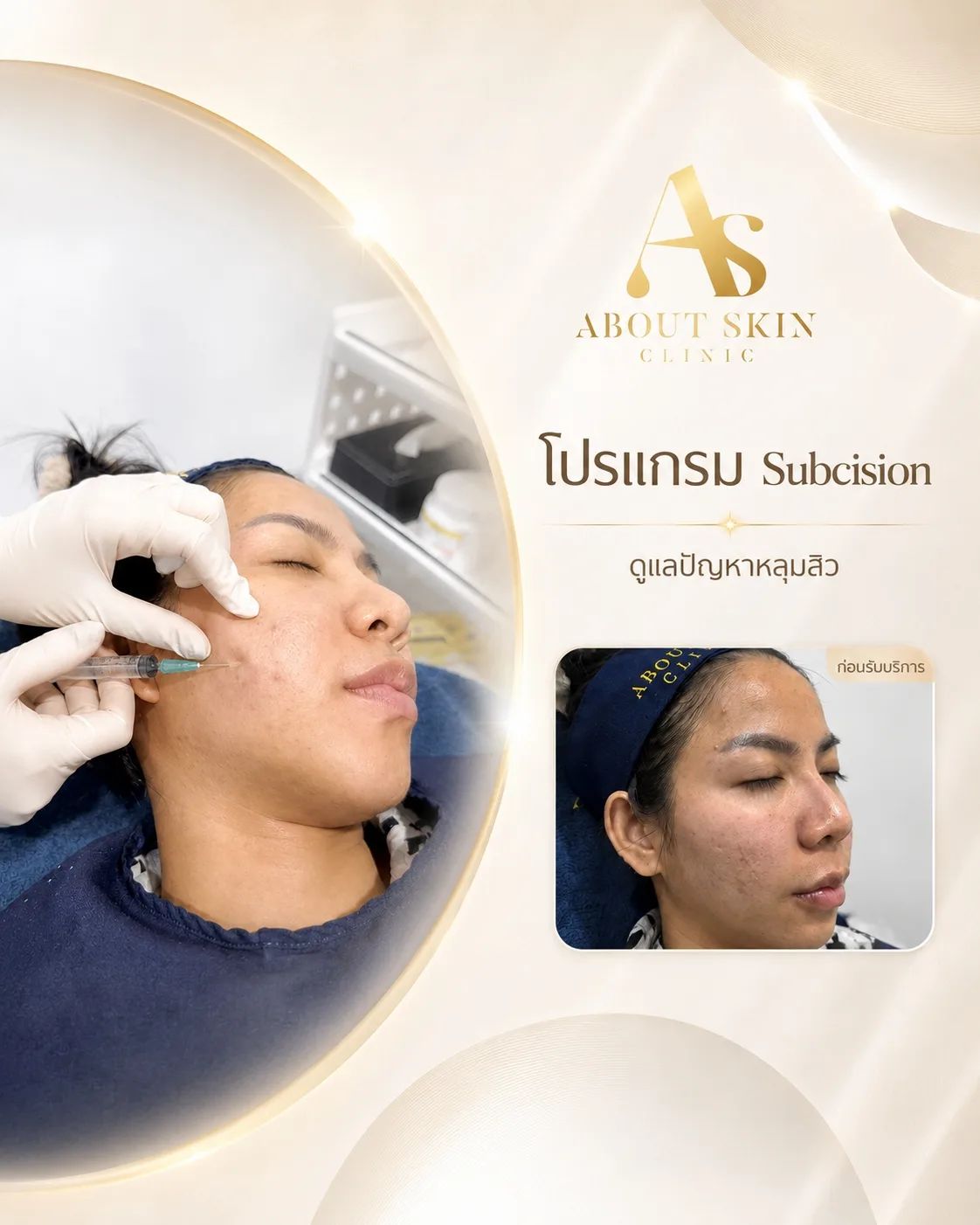 หมอกำลังทำหัตถการ Subcision จริง About Skin Clinic