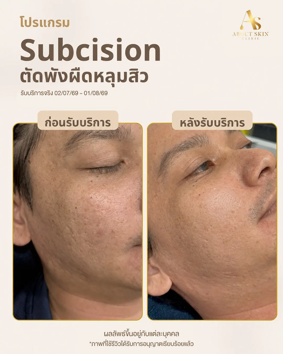 ผลลัพธ์ก่อนหลัง Subcision หลุมสิว About Skin Clinic เคส 2