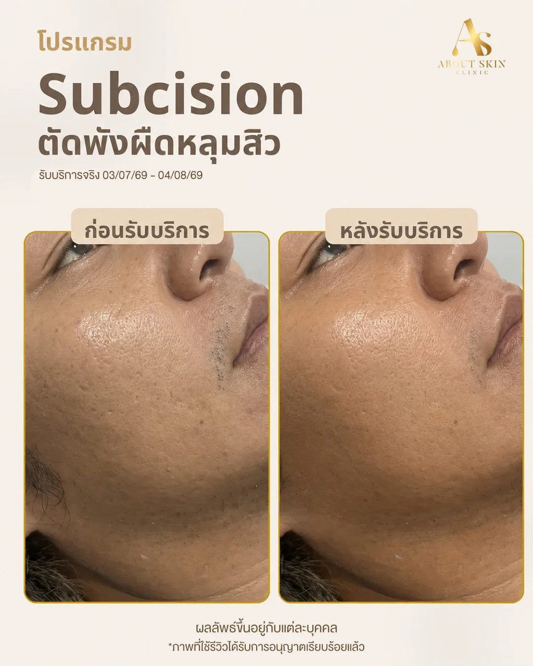 ผลลัพธ์ Subcision หลุมสิว About Skin Clinic