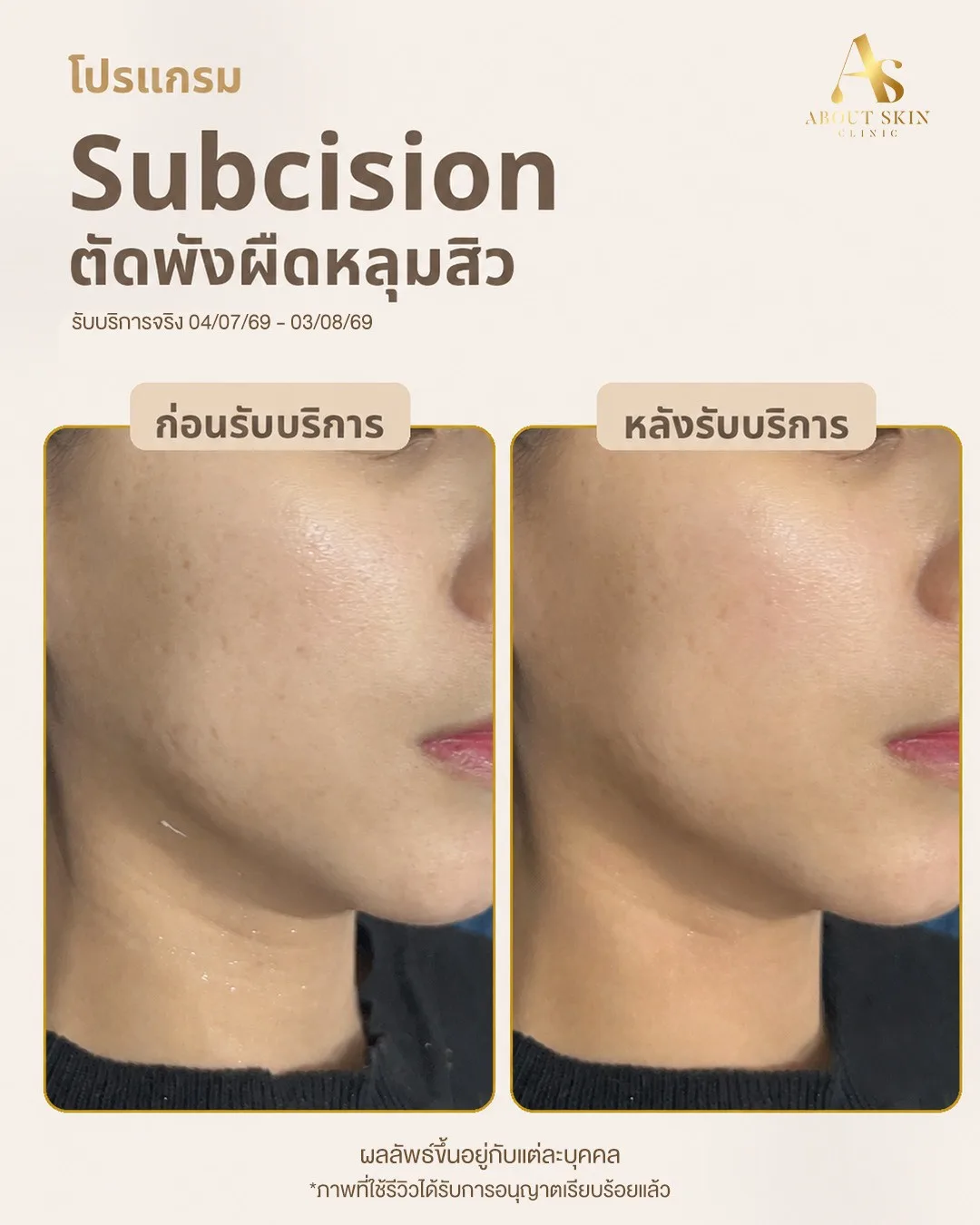 ผลลัพธ์ก่อนหลัง Subcision หลุมสิว About Skin Clinic เคส 4