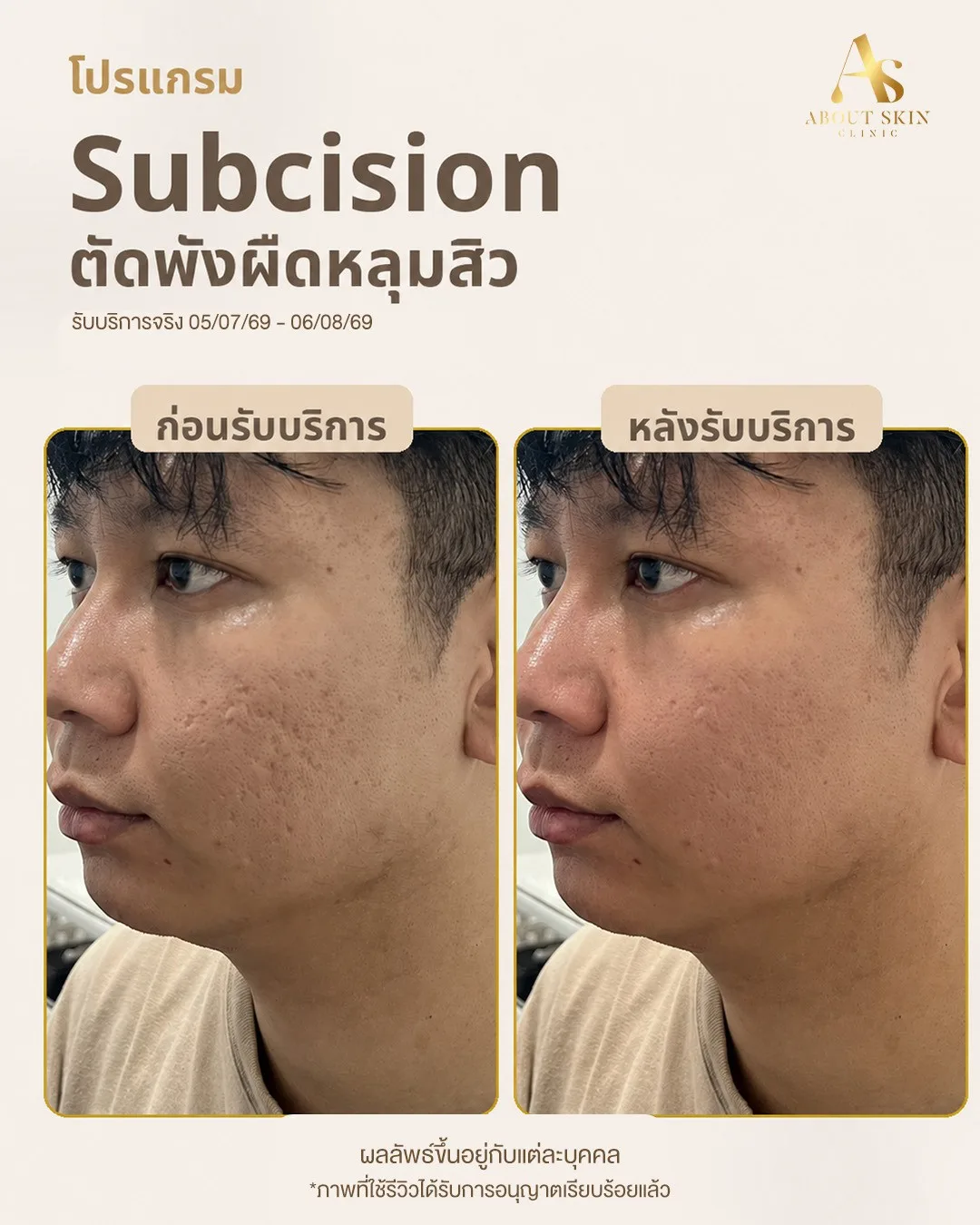 ผลลัพธ์ก่อนหลัง Subcision หลุมสิว คนไข้ชาย About Skin Clinic
