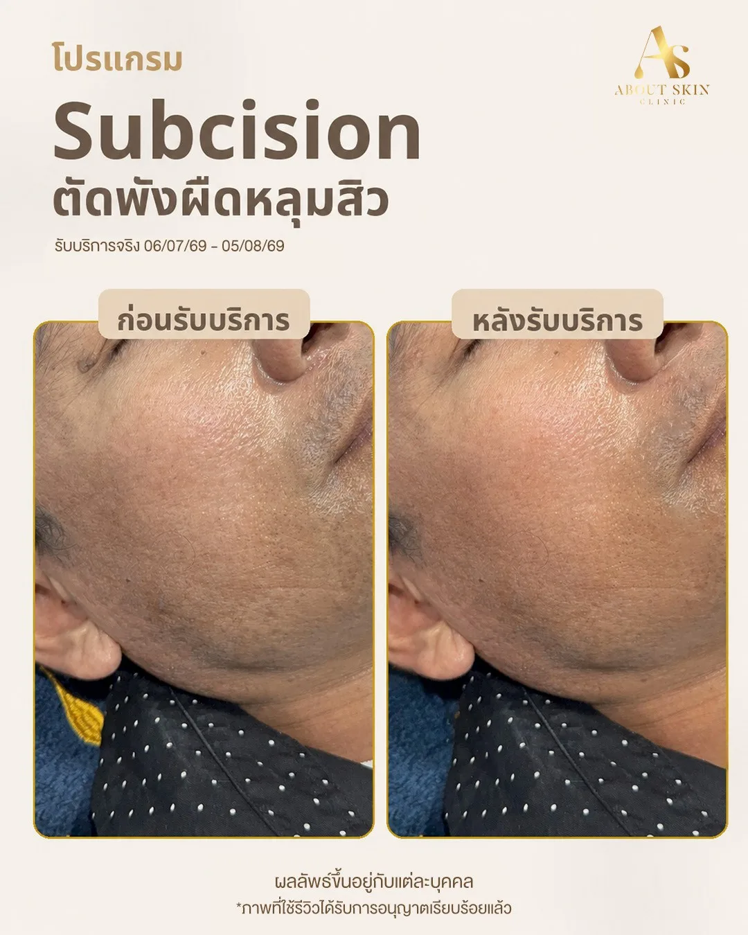 ผลลัพธ์ก่อนหลัง Subcision หลุมสิว About Skin Clinic เคส 6