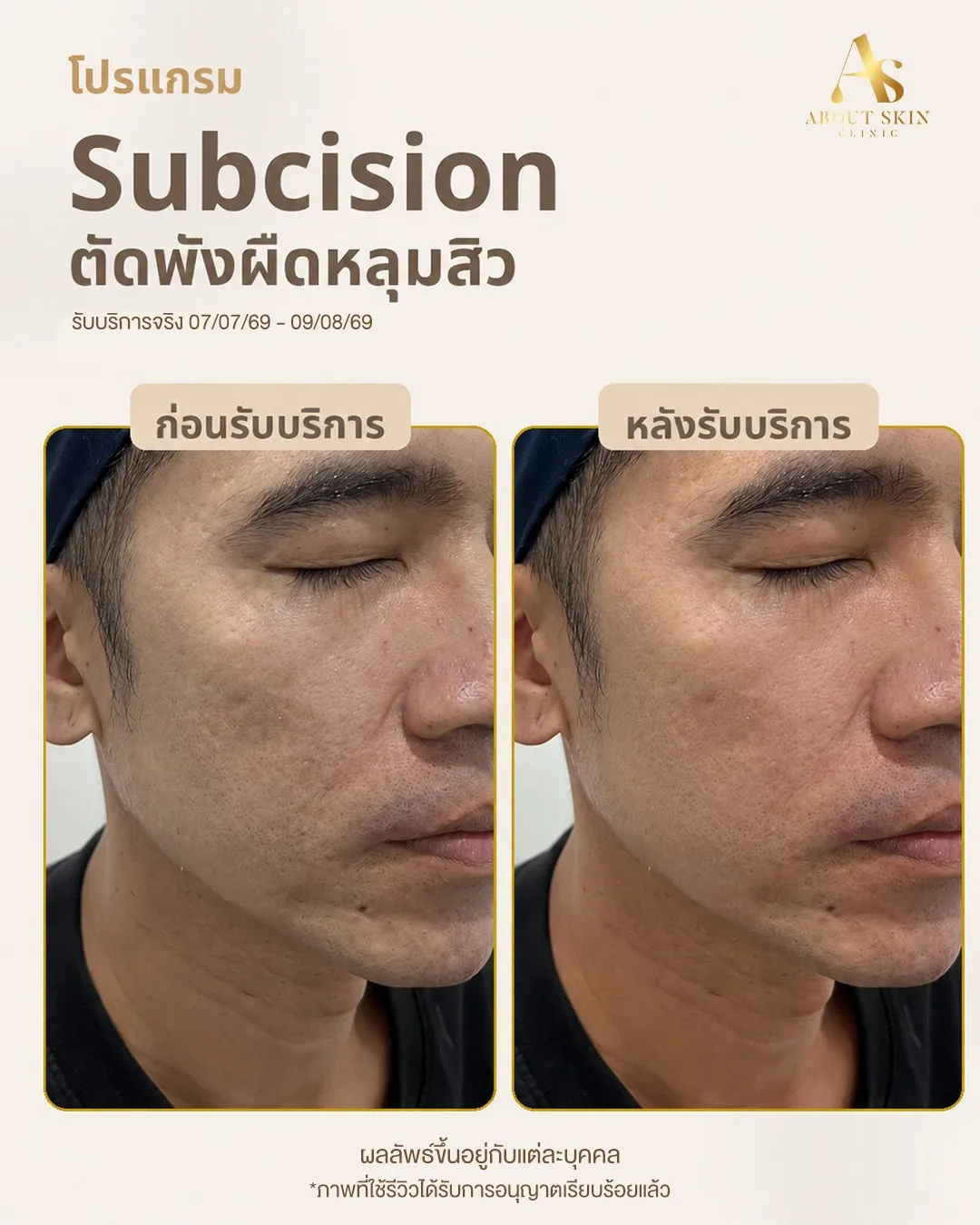 ผลลัพธ์ก่อนหลัง Subcision หลุมสิว About Skin Clinic เคส 7