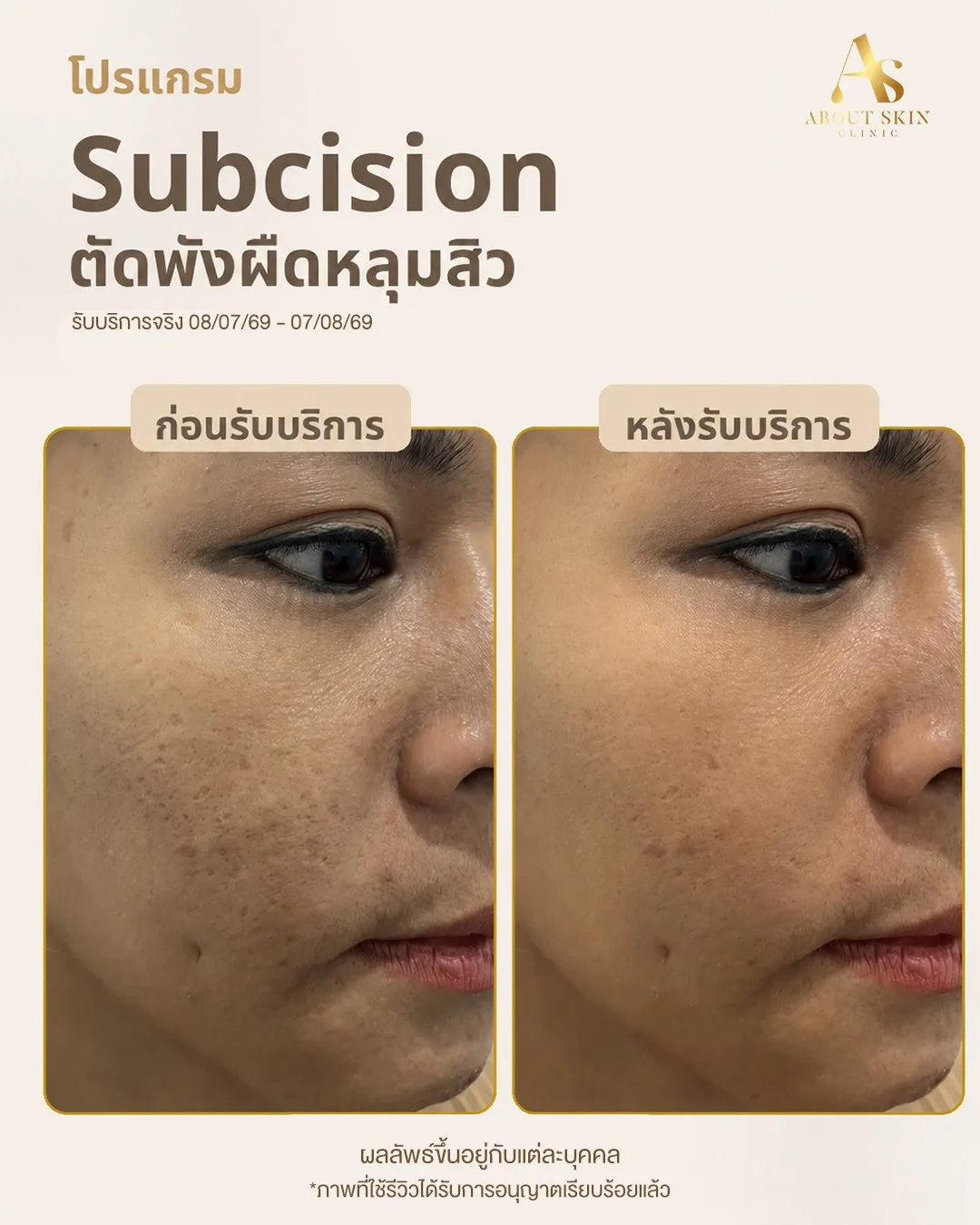 ผลลัพธ์ก่อนหลัง Subcision หลุมสิว About Skin Clinic
