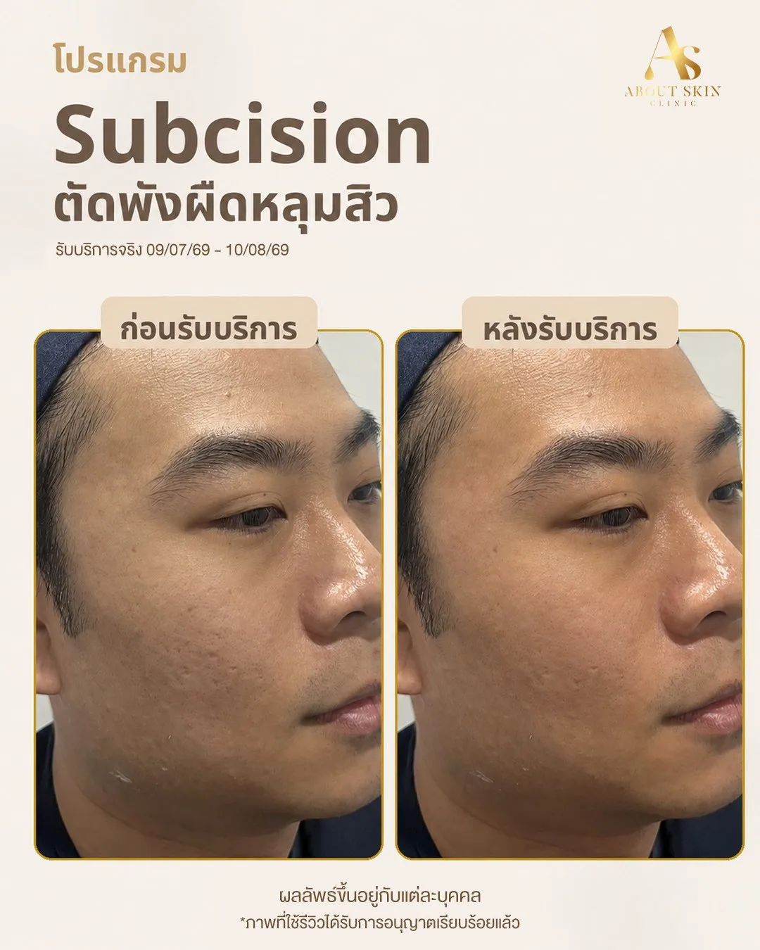 ผลลัพธ์ก่อนหลัง Subcision หลุมสิว About Skin Clinic เคส 9