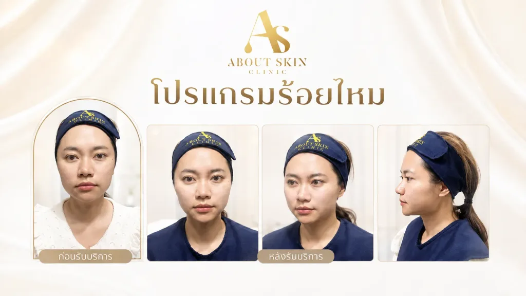 โปรแกรมร้อยไหม เคสจริง About Skin Clinic