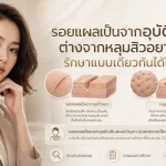 ภาพประกอบบทความ รอยแผลเป็นจากอุบัติเหตุ ต่างจากหลุมสิวอย่างไร รักษาแบบเดียวกันได้ไหม - About Skin Clinic