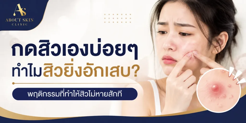 ภาพประกอบบทความ กดสิวเองบ่อยๆ ทำไมสิวยิ่งอักเสบ? พฤติกรรมที่ทำให้สิวไม่หายสักที | About Skin Clinic เพชรเกษม - About Skin Clinic