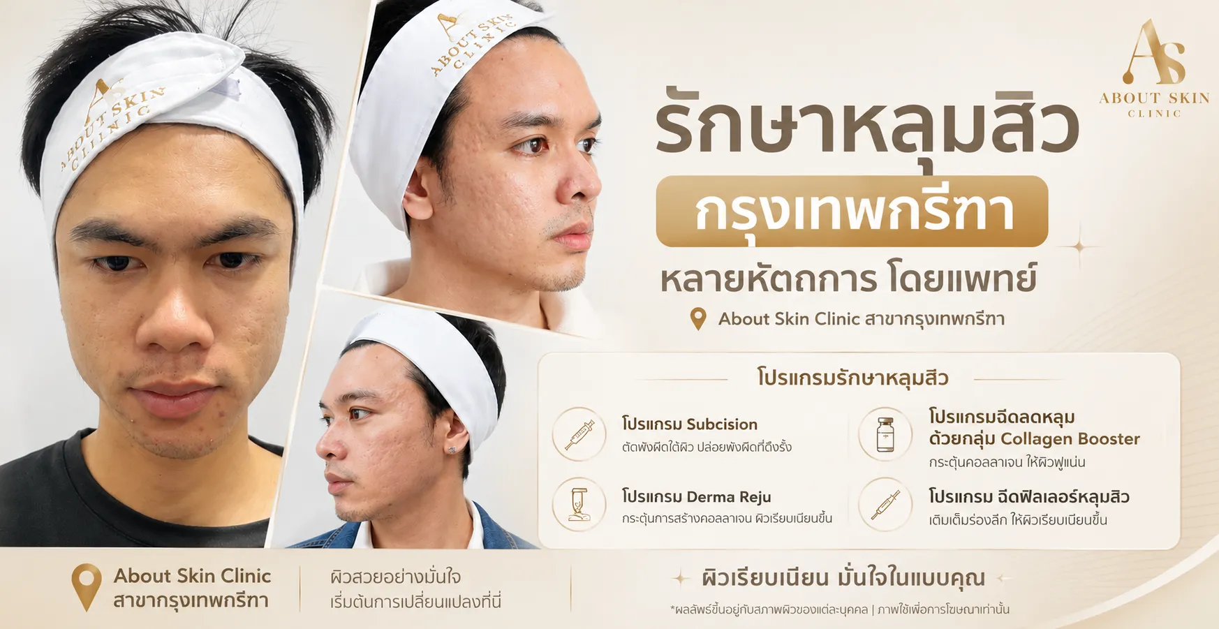 รักษาหลุมสิว กรุงเทพกรีฑา About Skin Clinic