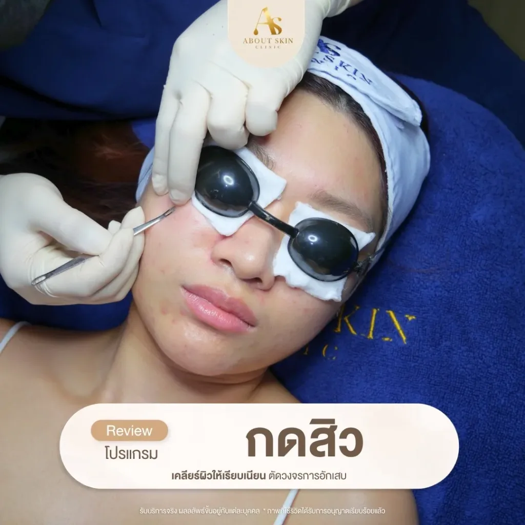 โปรแกรมกดสิว About Skin Clinic