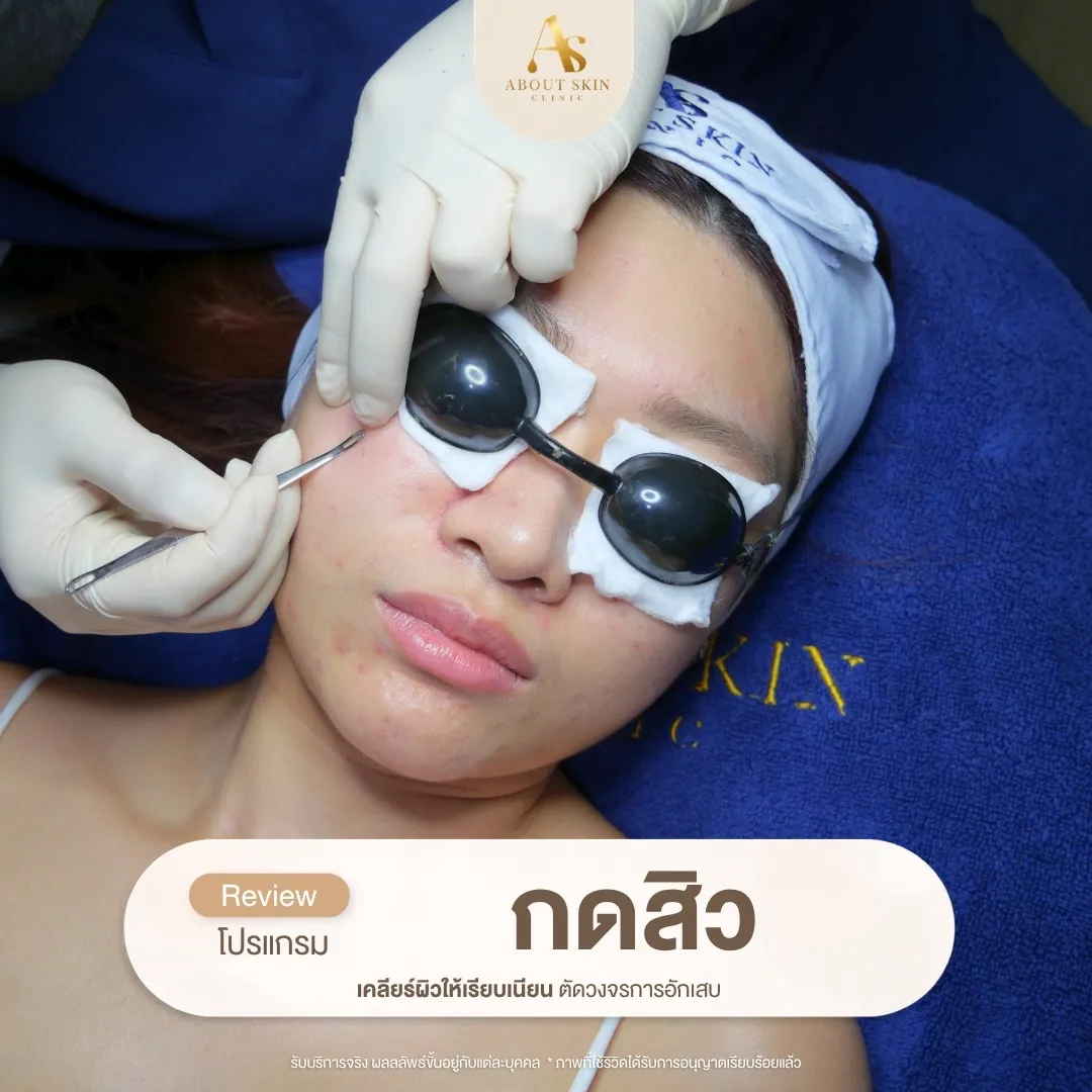 โปรแกรมกดสิว About Skin Clinic