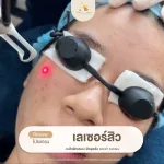 โปรแกรมเลเซอร์สิว About Skin Clinic