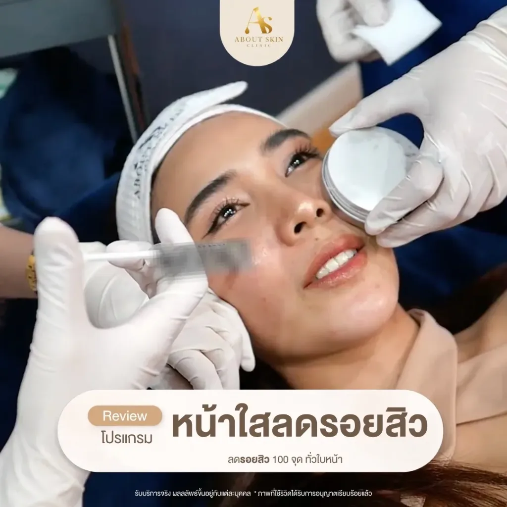 โปรแกรมหน้าใสลดรอยสิว 100 จุด About Skin Clinic