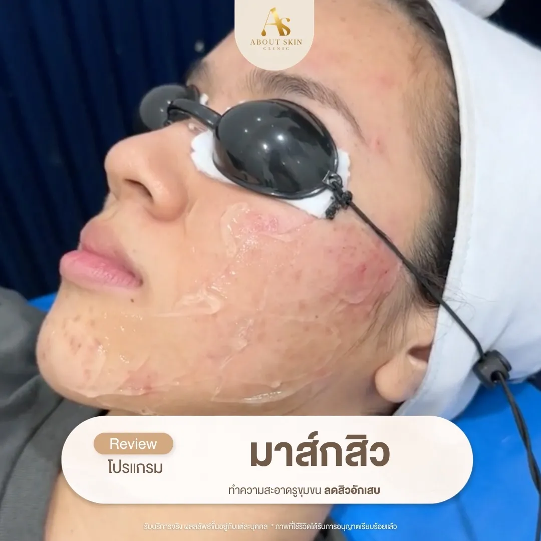 โปรแกรมมาส์กสิว About Skin Clinic