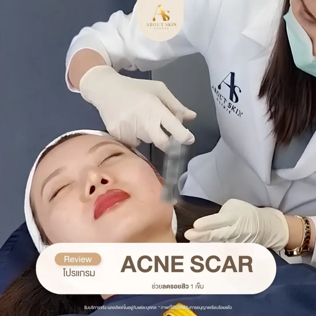 โปรแกรม ACNE SCAR 1 เข็ม About Skin Clinic