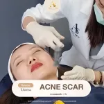 โปรแกรม ACNE SCAR 1 เข็ม About Skin Clinic