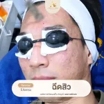 โปรแกรมฉีดสิว About Skin Clinic