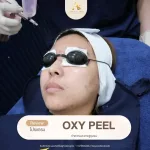โปรแกรม OXY PEEL ล้างรูขุมขน About Skin Clinic