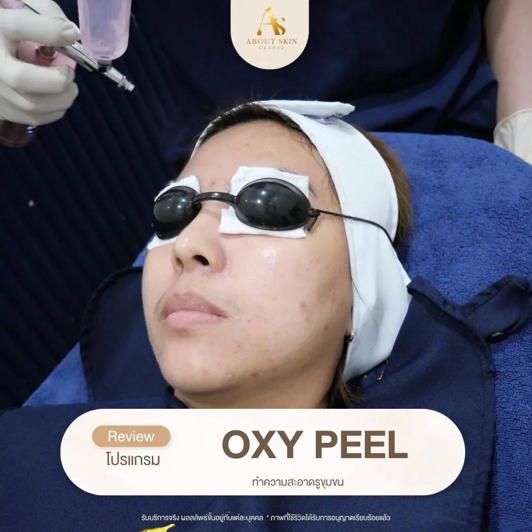 โปรแกรม OXY PEEL ล้างรูขุมขน About Skin Clinic